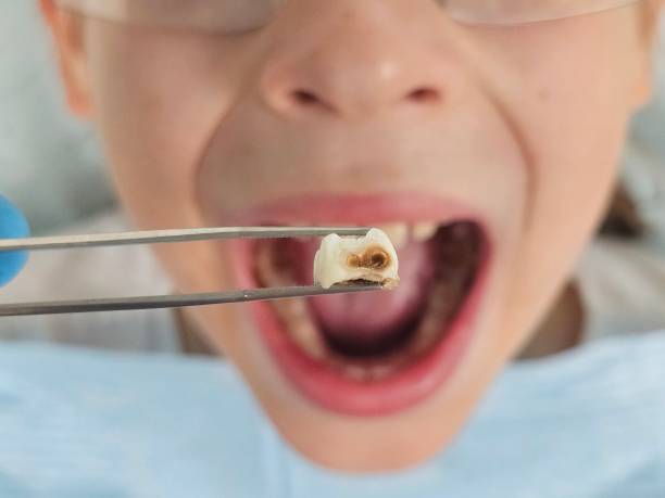 Best Emergency Dental Extractions in Fairview, NC